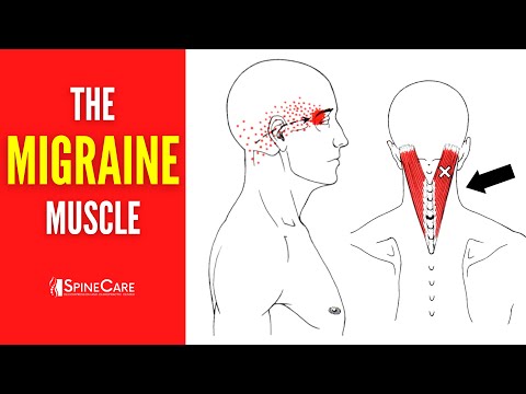 How to Release Tension for FAST MIGRAINE RELIEF