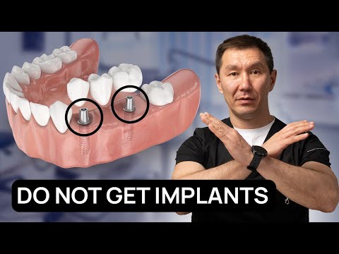 Don't Get Implants Until You Know This! Dentists Don't Tell You The Truth
