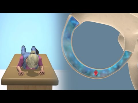 Lempert (BBQ) Maneuver to Treat BPPV Vertigo