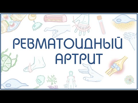 Ревматоидный артрит - причины, патогенез - в схемах и рисунках
