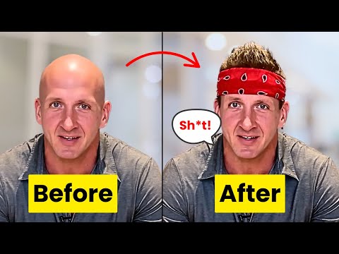 $3000 Hair Transplant Mistake in Thailand? What They DON'T Show You