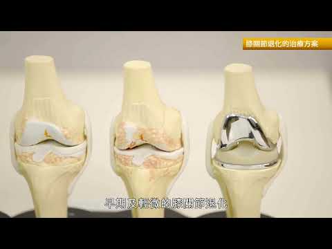 港怡醫院 — 機械臂輔助全膝關節置換手術 　減低翻修率