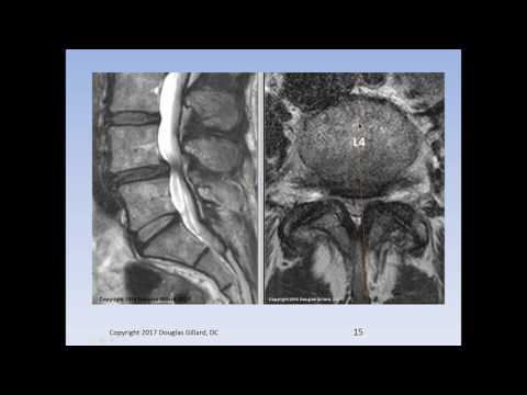 Lumbar Spinal Stenosis, Cauda Equina Syndrome, Sciatica, & Disc Herniation: An Advanced Lecture.