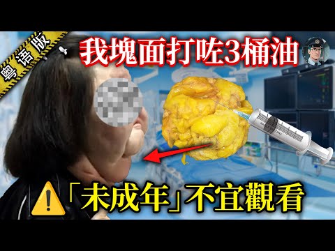 10年整容上百次！韓國model從神似王祖賢到「電扇頭」，塊面取出3.5公斤矽膠異物，佢嘅經歷令整容業震驚！【鐘sir講案】韓國案件 韓國財閥 案件解說