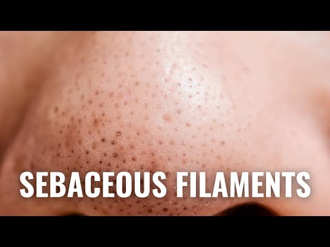 How To Get Rid of Sebaceous Filaments QUICKLY