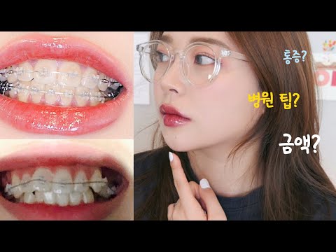 Getting braces that give the effect of plastic surgery & Everything about getting braces at 25