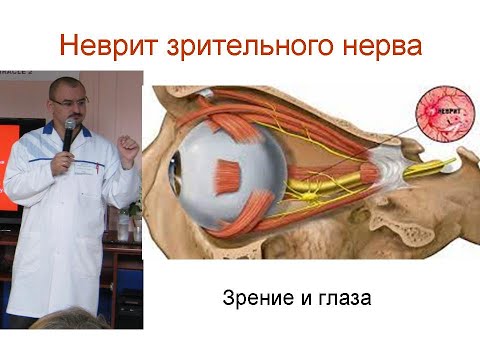 Optic neuritis. Its manifestation and treatment.