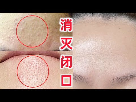 28天清除閉口 日本美容師教你在家正確刷酸去閉口