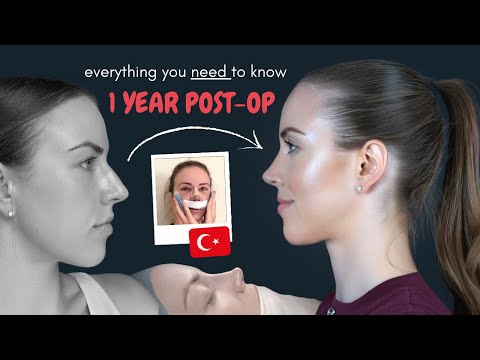 Rhinoplasty in Turkey | 1 Year Post-Op Nose Job Update + Q&A (2025)