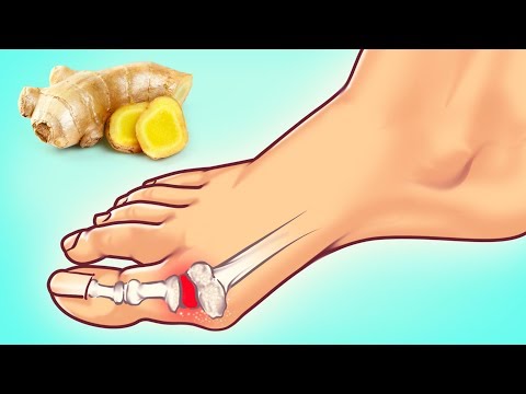 10 Astuces D’experts Pour Combattre Une Crise de Goutte