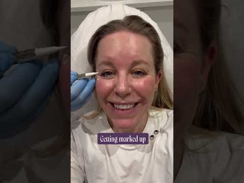 We tried the new toxin injection that works in 36 hours 😮