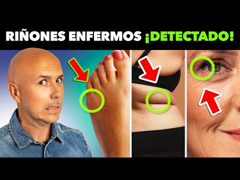 ¡PROBLEMAS RENALES! Signos OCULTOS Que Podrías Tener Y NO Saberlo | Ver Si Tienes Más De 40