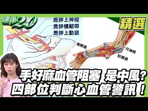 手麻憂心臟問題？手好麻血管阻塞中風 從四部位判斷心血管警訊！【健康2.0精選】