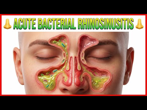 Acute Bacterial Rhinosinusitis 👃 (ABRS) : ENT Lectures