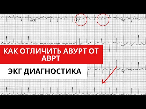 Supraventricular tachycardias. How to distinguish AVNRT from AVRT. ECG diagnostics.
