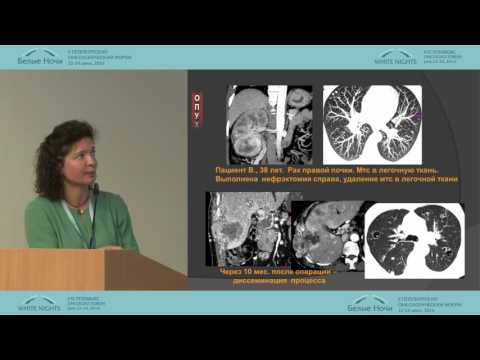 Лучевая диагностика опухолей почек