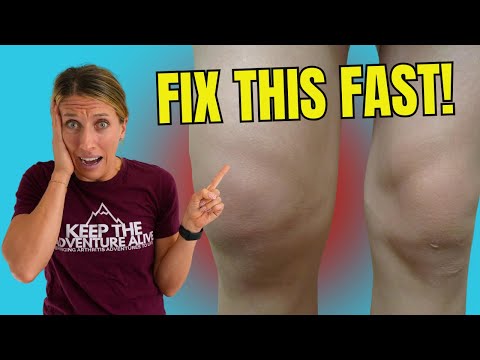 Struggling with Knee Swelling? 3 Proven Ways to Bring It Down Fast!