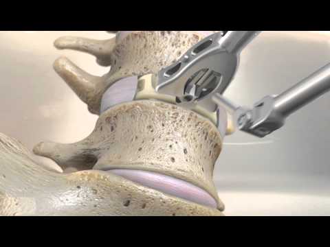 STALIF M™ (MIDLINE II) Surgical Technique Animation | Anterior Lumbar Interbody Fusion