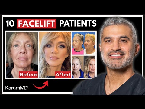 10 Real Facelift Results That Look Natural - Facial Rejuvenation Before & After