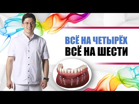 All-on-four / All-on-six [ Всё на четырёх, Всё на шести ]. Зубы за один день на 4 или 6 имплантах.