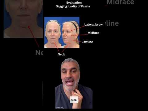FACELIFT TRANSFORMATION! Plastic Surgeon's Pre-Facelift Analysis