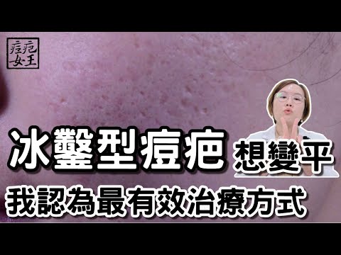 嚴重痘疤怎麼消?難治療的冰鑿型痘疤!皮膚專科莊盈彥醫師來大揭密!