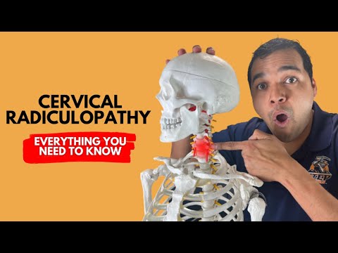 Cervical Radiculopathy: Everything You Need To Know To Get Better Without Surgery