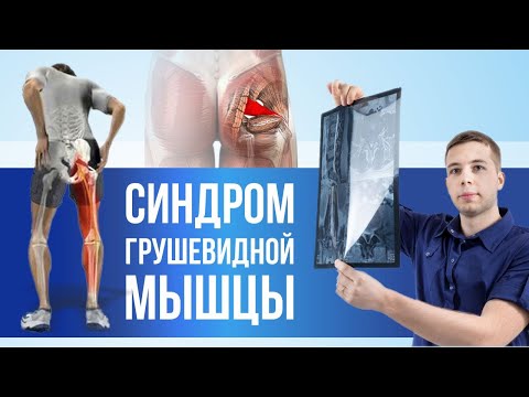 ГРУШЕВИДНАЯ МЫШЦА (синдром) - самое полное видео на Ютуб. Лечение, упражнения, блокада