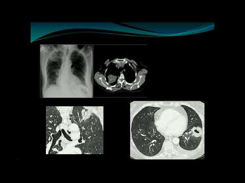 Stratification of lung nodules and the new Fleischner guidelines - Theresa McLoud