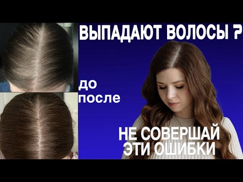 ВЫПАДЕНИЕ ВОЛОС | об отмене миноксидила | не совершай эти ошибки если выпадают волос
