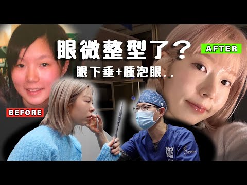 偷偷去割雙眼皮了?!!眼型變化全公開⋯鬆弛浮腫+像未睡飽很困擾！為什麼我樣子變化這麼大！醫生竟然說(嚇)⋯