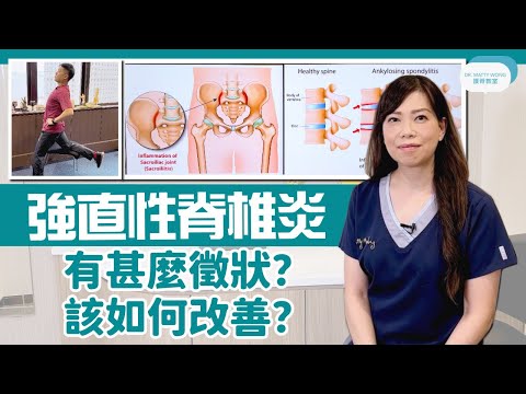 強直性脊椎炎, 有什麼徴狀, 該如何改善, 拉筋舒緩晨僵 !!脊醫王鳳恩