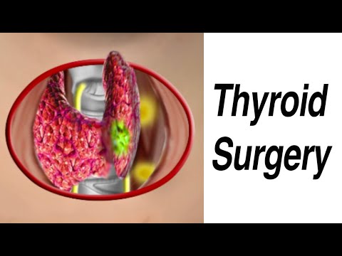 Thyroid Surgery to Remove Nodule Suspicious for Cancer