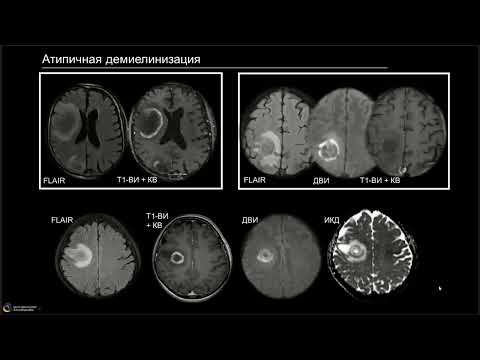 Вебинар: «Демиелинизирующие процессы: о чем помнить помимо рассеянного склероза?»