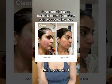 I tracked my entire skin journey with progress pics and medication history on my skincare app Clear