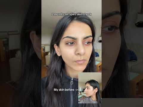 Two months on spironolactone skin check! #skincare #acne #dermatology #spiro