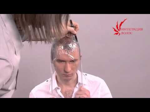 Система замещения волос у мужчин