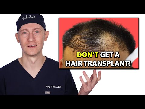 10 Reasons - Do Not Get A Hair Transplant | Hair Surgeon Reacts
