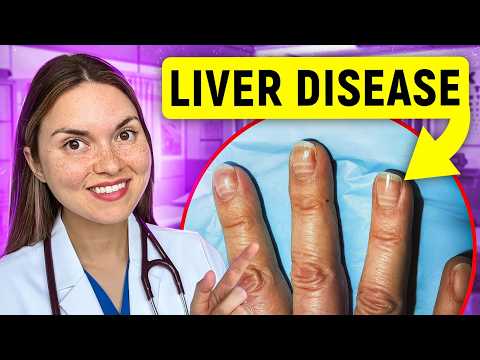 12 Signs of LIVER DISEASE You Can See: Doctor Explains