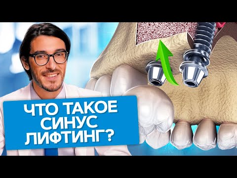 Что такое синус лифтинг? Что нужно знать о синус лифтинге и какие последствия ждут пациента?