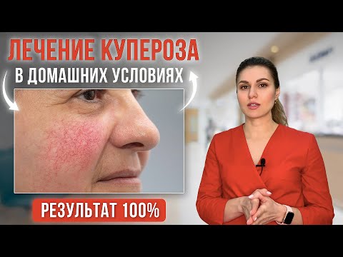 Купероз на лице как избавиться, почему появляется. Лечение купероза в домашних условиях.