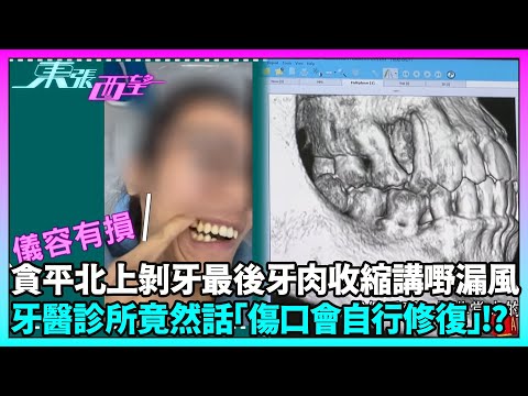 東張西望｜再有港人赴內地牙科診所遭遇不愉快經歷！剝牙後傷口出現大洞引致牙肉萎縮 專業處理引爭議｜TVBUSA｜民生