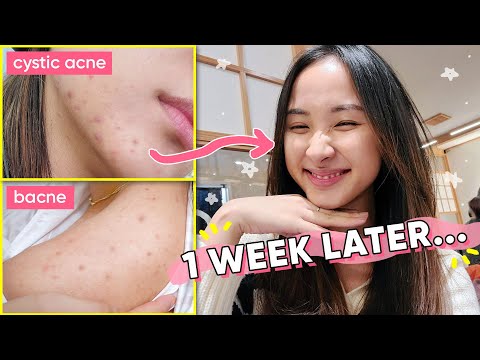 ~1 THING~ that healed & reset my hormonal acne, NATURALLY | Acne Series