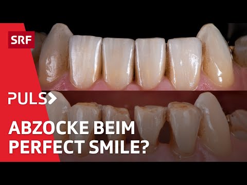 Veneers, Bleaching und Co – der hohe Preis perfekter Zähne | Puls | SRF Wissen