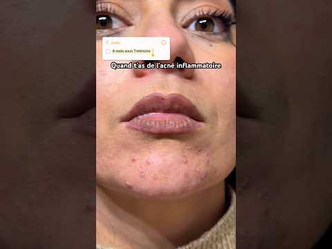 Acné inflammatoire : #adapalene #tretinoin mon expérience 😭