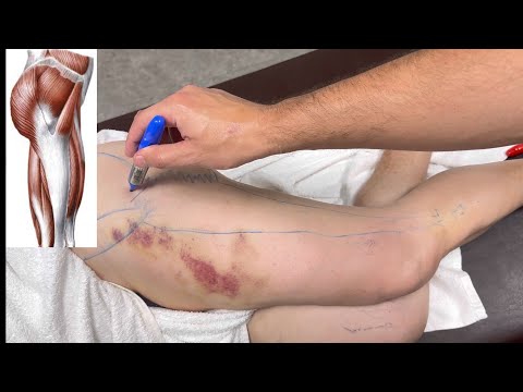 Как навсегда избавиться от боли в ноге?! Просто повторяйте! Deep tissue massage. Миопрессура
