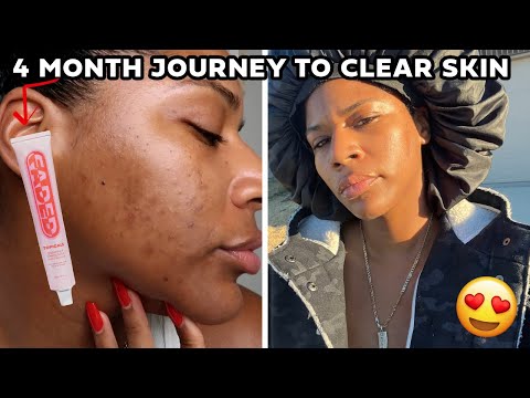 4 Month Update with Topicals Faded Serum: Goodbye to Hyperpigmentation