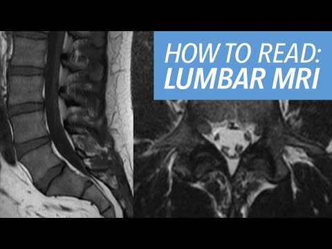 How to Read an MRI of the Lumbar Spine: A Beginner's Approach