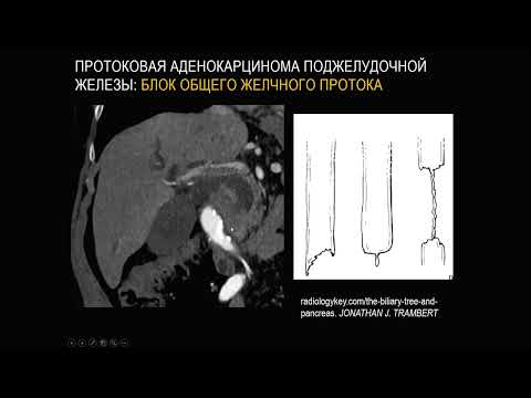 Рак поджелудочной железы Часть 1