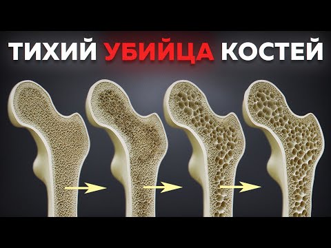 ПРИЧИНА слабых костей НЕ в дефиците кальция! / Быстрый тест на здоровье костей